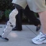 Un avance de tecnología integrada en una pierna biónica